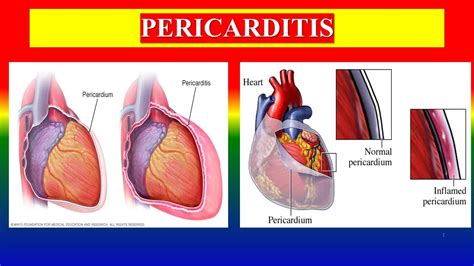 Pericarditis Define Types Etiology Risk Clinical Diagnostic