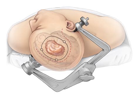 Convexity Meningioma The Neurosurgical Atlas