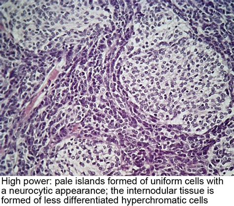 Pathology Outlines Desmoplastic Nodular Medulloblastoma