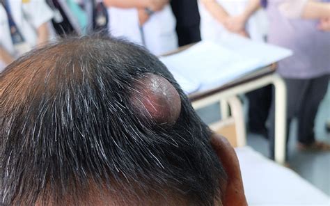 Infected Sebaceous Cyst In Scalp