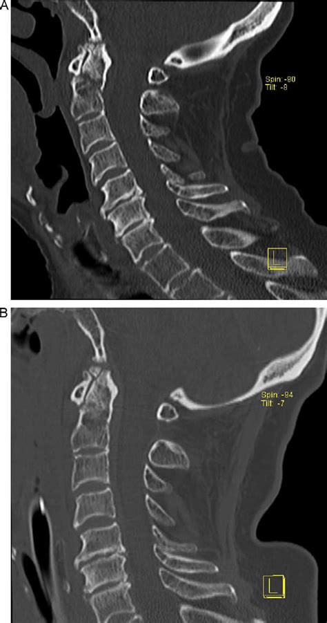 Computed Tomography Scan Of The Cervical Spine A The Scan Download Scientific Diagram