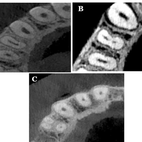 Different variations of root canal types in maxillary first premolar; A ...