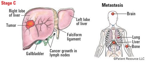 Liver Cancer Staging Systems