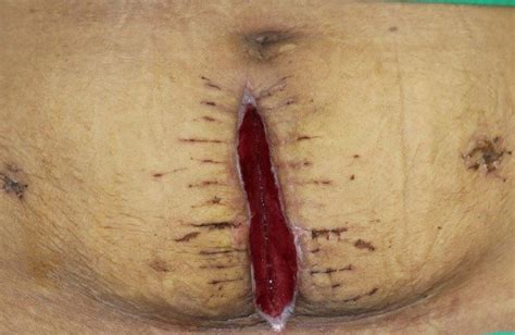 Preoperative Photograph Of Abdominal Wound Preoperative State Shows