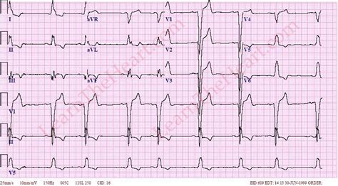 Sinus rhythm with pac ecg 671152-Sinus rhythm with pac treatment