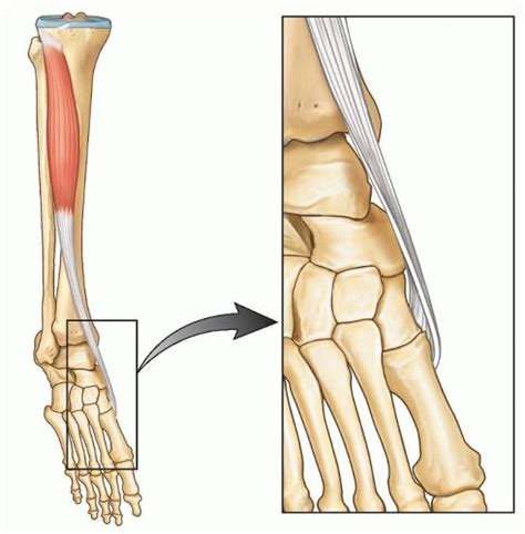 Anterior Tibialis Tendonitis