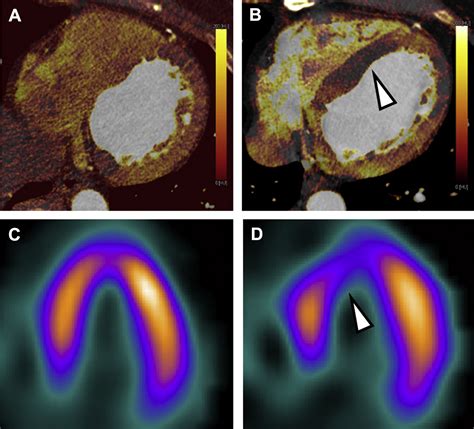 Dual Energy Computed Tomography In Cardiothoracic Vascular Imaging