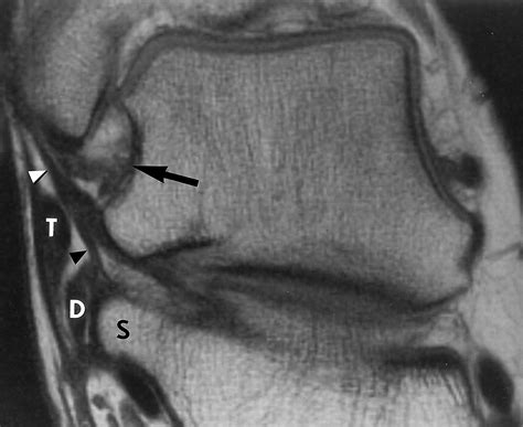 Collateral Ligaments Of The Ankle High Resolution Mr Imaging With A