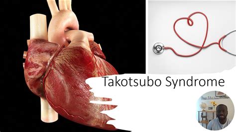 Takotsubo Syndrome Cardiomyopathy YouTube