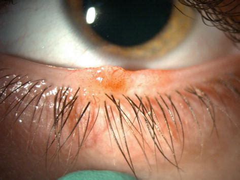 Pigmented Lesions Of The Eyelid Margin Intechopen