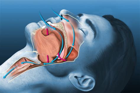 The Impact Of Obstructive Sleep Apnea On Brain Health And Overall Well