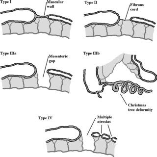 Apple Peel Atresia Usmle