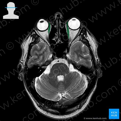 Medial rectus: Origin, insertion, innervation, action | Kenhub