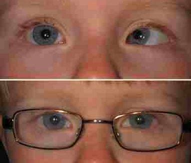 Esotropia - Definition, Surgery, Treatment, Causes, Surgery