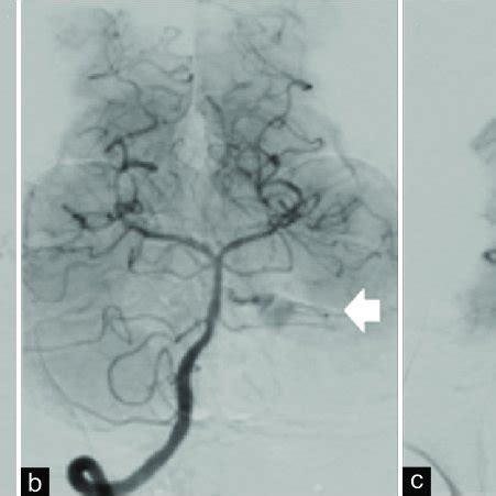 Digital Subtraction Angiography Dsa On Admission Dsa In An Arterial