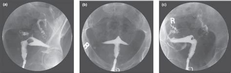 Retroverted Uterus Hsg