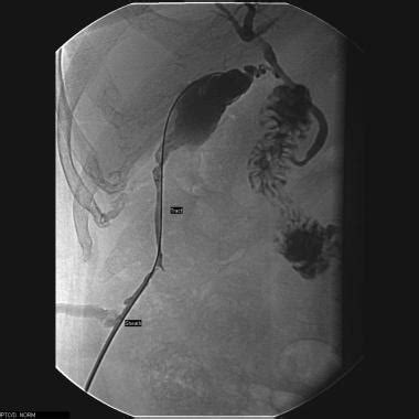 Percutaneous Cholecystostomy Technique: Percutaneous Cholecystostomy ...