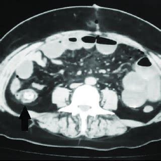 Tomograf A Computarizada Abdominal Que Muestra Una Imagen Hiperdensa En