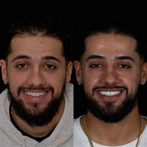 Gallery: Before and After Dental Veneers in Los Angeles, CA | Smiles By