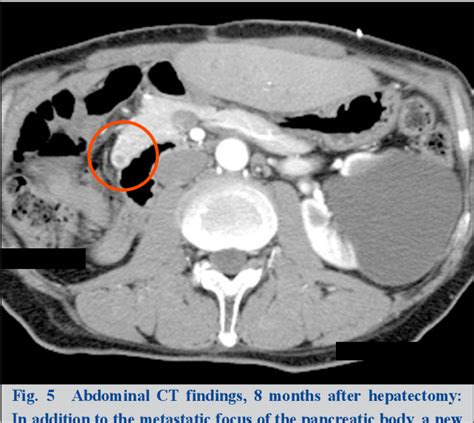 Figure 5 From A Case Of Primary Hepatic Solitary Fibrous Tumor With