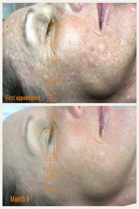 Acne Scars And Hyperpigmentation — The Acne Lab