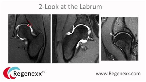 Hip Bone Spur Removal - Why You Should Avoid It - Regenexx Blog