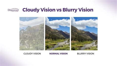 Cloudy Vision Causes Treatment And More Discover Vision