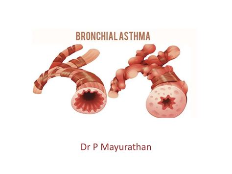 Bronchial Asthma And Its Clinical Presentations PPT