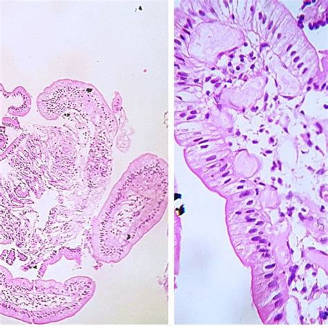 H And E Primary Intestinal Lymphangiectasia A Broadening Of Few Villi Download Scientific