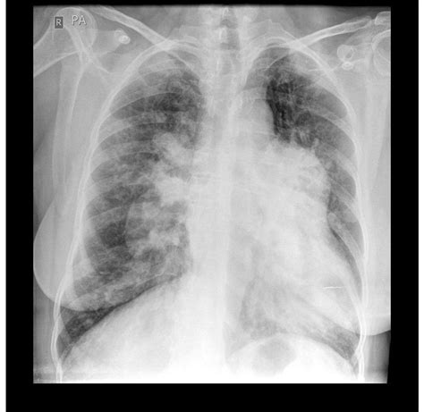 Systemic lupus erythematosus x ray - wikidoc