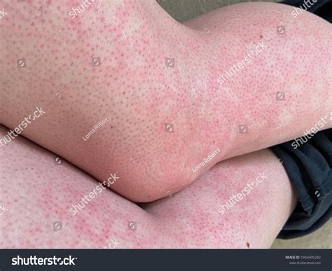 Mottled Skin Heat Rash Hives Allergy库存照片1954405282 Shutterstock