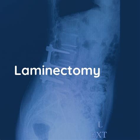 Laminectomy - Professor Akbar Ali Khan