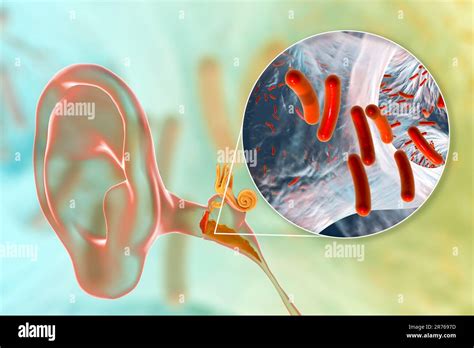 Otitis Media Ear Infection And Closeup View Of Bacteria The