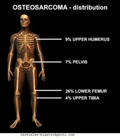 Tumore Osseo Sintomi Segni Metastasi Terapia E Sopravvivenza