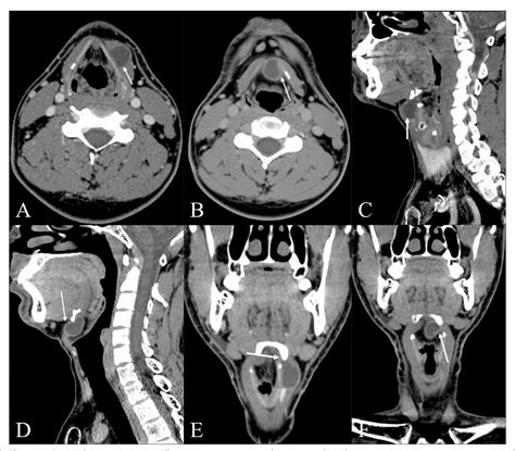 Figure From Migratory Intralaryngeal Thyroglossal Duct Cyst