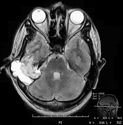 Preoperative Cranial Mri With Axial T2 Weighted Image Showing A Large