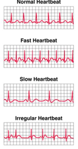 3 Arrhythmia Flashcards Quizlet