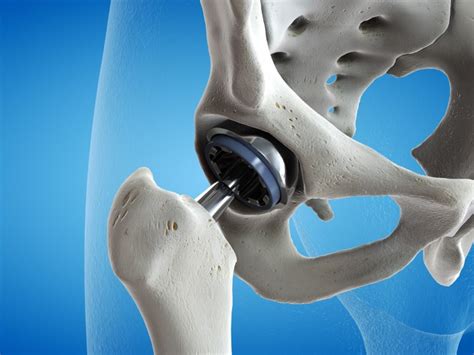 Hip Fracture Treatment Melbourne Malvern Werribee MOATI