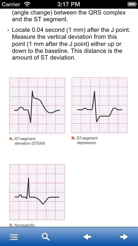 Stemi St Segment Elevation Myocardial Infarction Iphone App