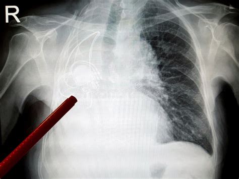 X-ray of the lungs stock image. Image of organ, disease - 165370795