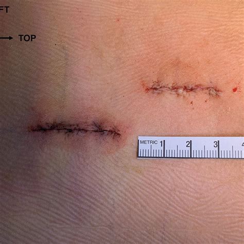 Intraoperative Photography At The End Of Surgery Showing The Two Scars