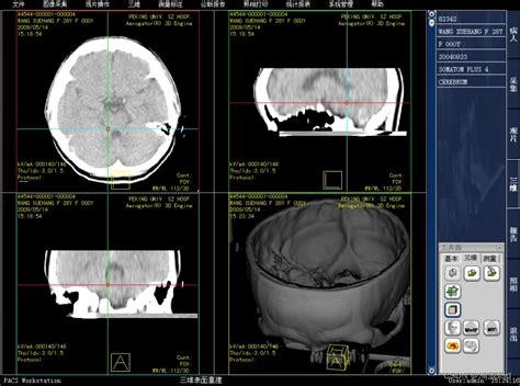 医学影像pacs系统源码：基于vc Mssql开发 支持三维重建和还原 哔哩哔哩