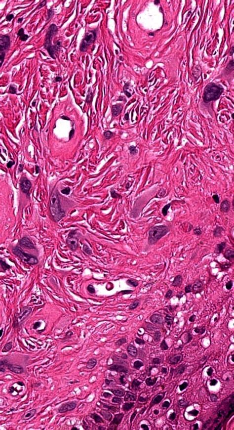 Pathology Of Fibrous Papule Of The Nose Medical School Motivation