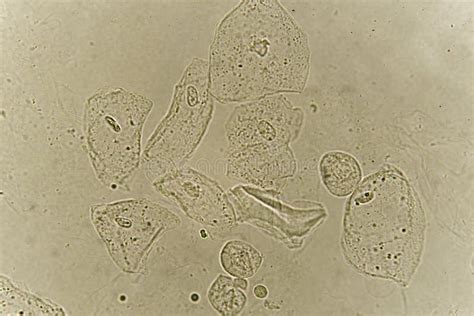 Urine Epithelial Cells Normal Range