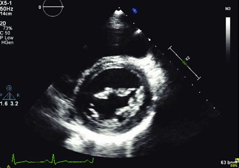 At The Mitral Valve Short Axis Level Myxomatous Changes Of The Mitral