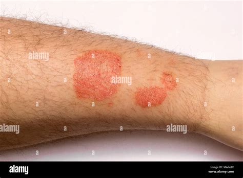 La Psoriasis De La Piel Close Up De Una Erupción Y Descamación En La Piel Del Paciente El