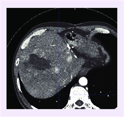 Viable Tissue Surrounding An Ablated Lesion In Patient With Multifocal