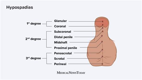 Hypospadias Causes Diagnosis And Treatment