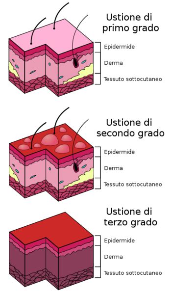 Scottature Rimedi Naturali Per Bruciature Ustioni