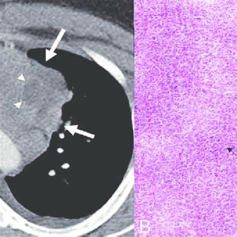 Thymic hyperplasia in a 26 year old boy who completed chemotherapy for... | Download Scientific ...